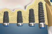 Bone condensation and internal Sinus Lift